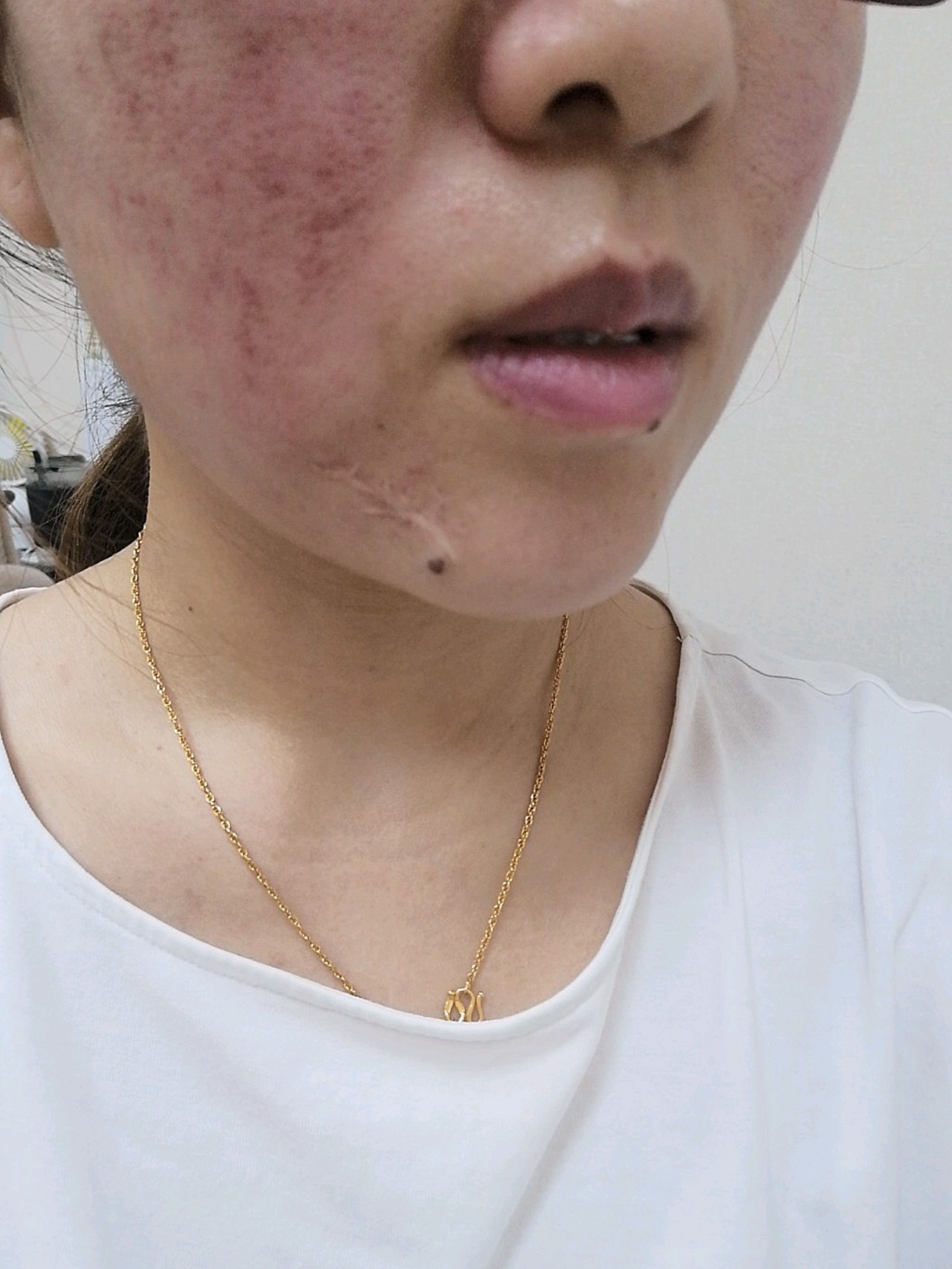 纯素颜热拉提治疗即可效果,刚做完出痧了,一般过个四五天就下去了