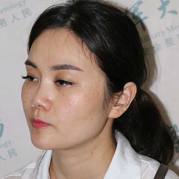 五官立体度术前鼻根和鼻尖都属于中重度塌陷了本来想着做隆鼻也是改善
