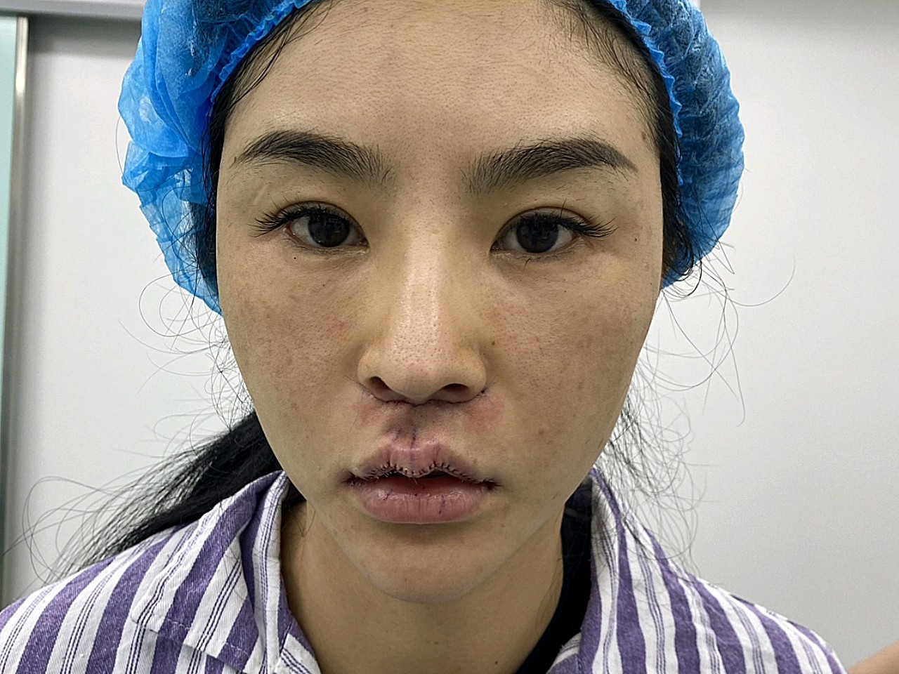 【人中缩短 m唇 内切上扬手术当天】人中长,苦瓜相_圈子-新氧美容整形