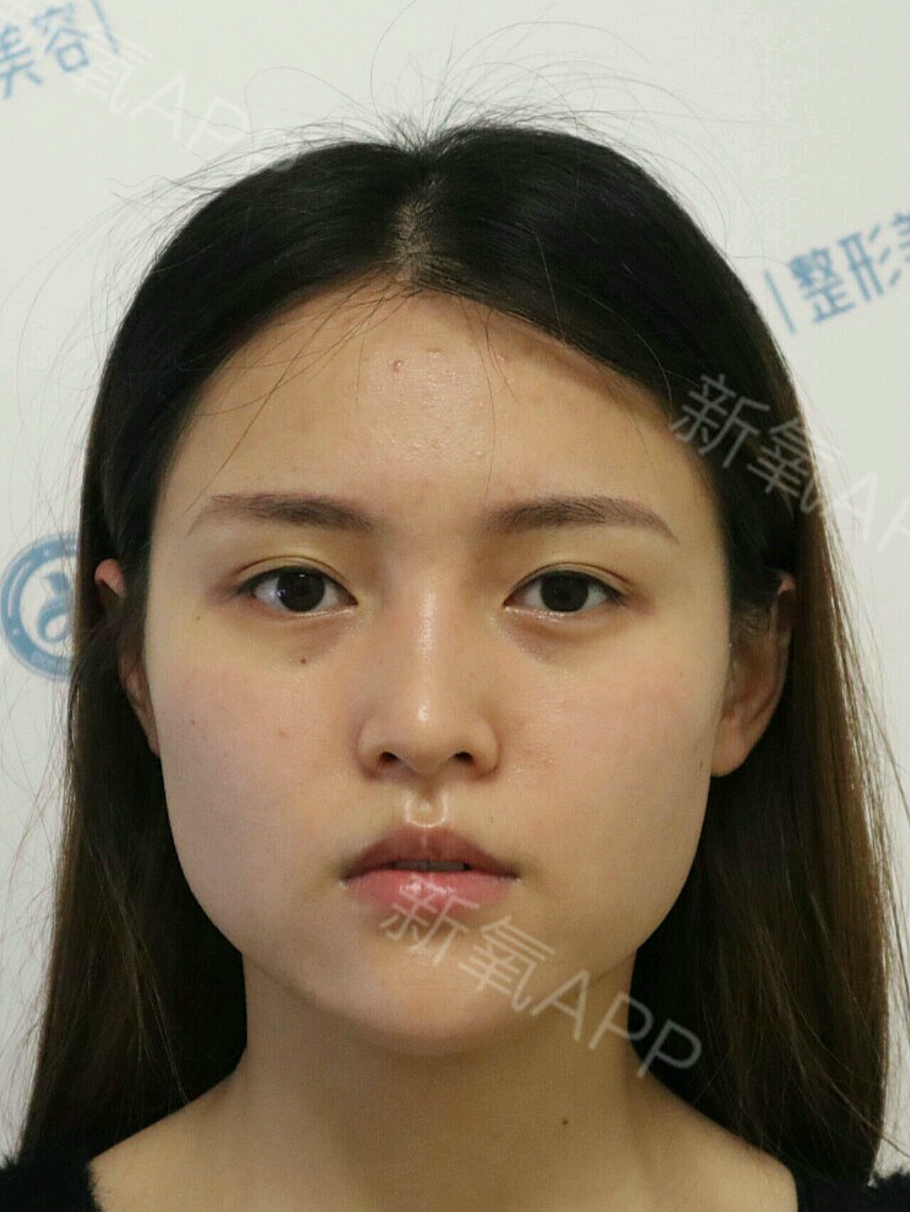 小v脸针_小v脸针_小v脸针