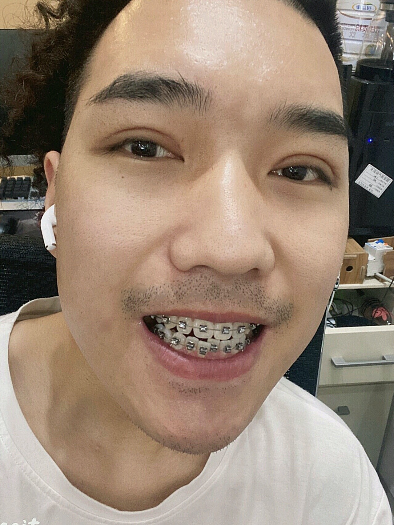 这个月粘下牙套啦