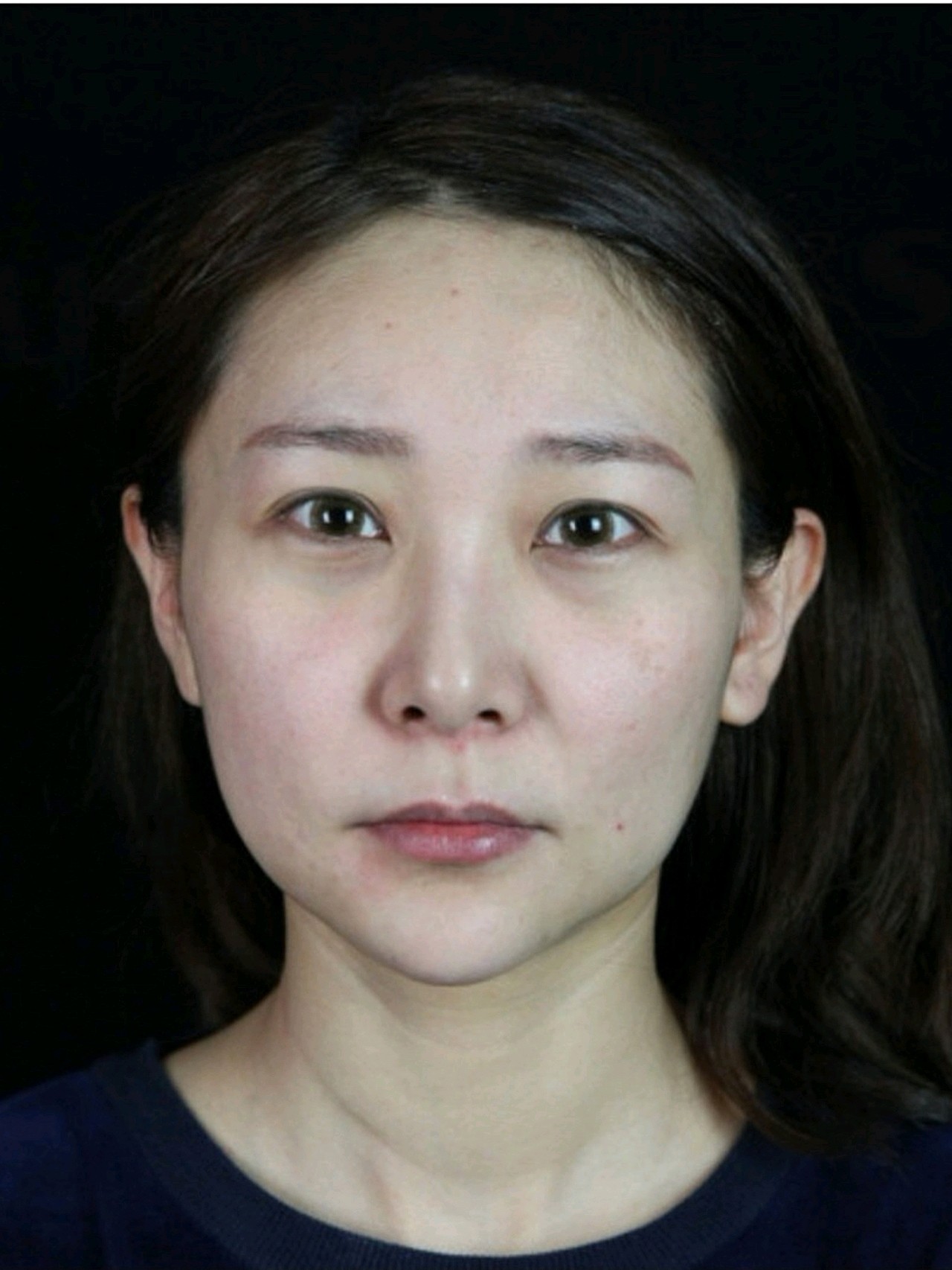 苹果肌下垂,下颌臃肿脸看着超级大!