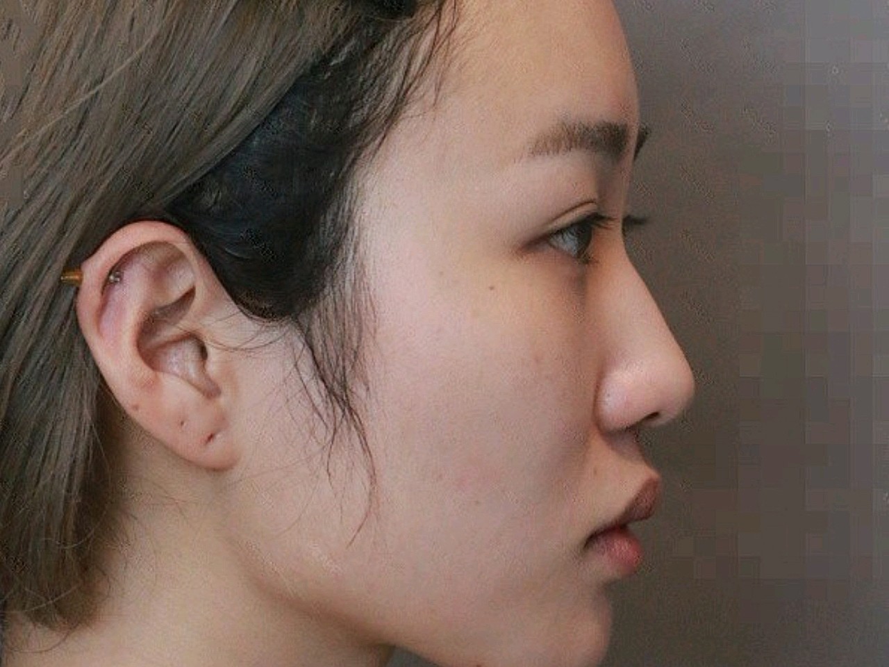 术前鼻子状况:鼻背细长但扁平,正面立体感弱,外形没_圈子-新氧美容