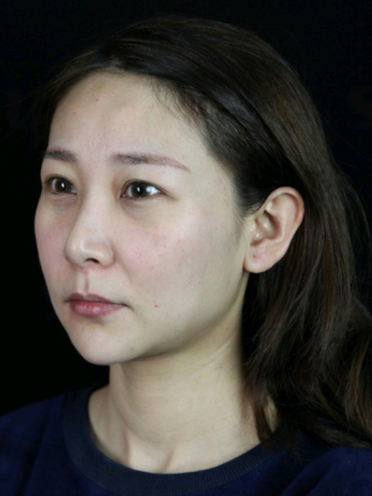 苹果肌下垂,下颌臃肿脸看着超级大!