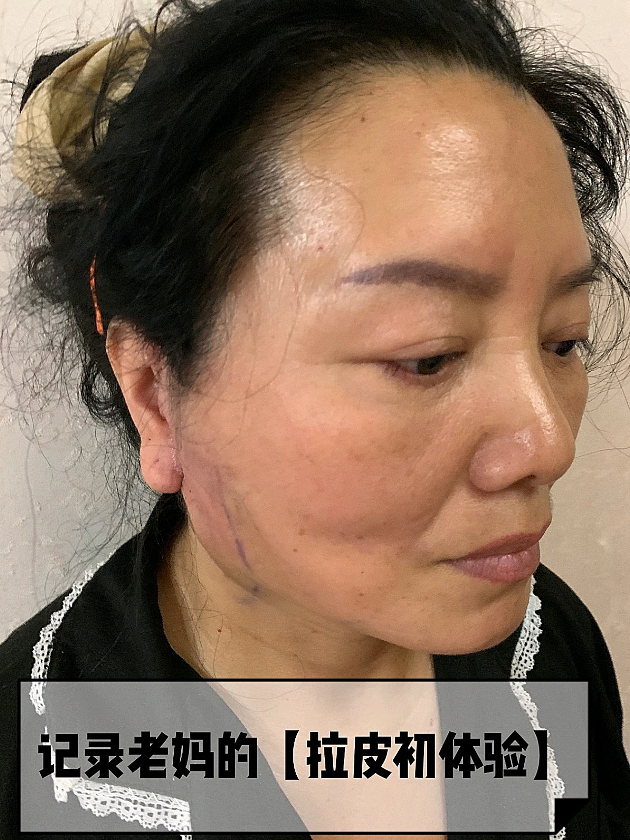 陪老妈去做了她心心念念好久的—拉皮98手术没有我想象_圈子-新氧