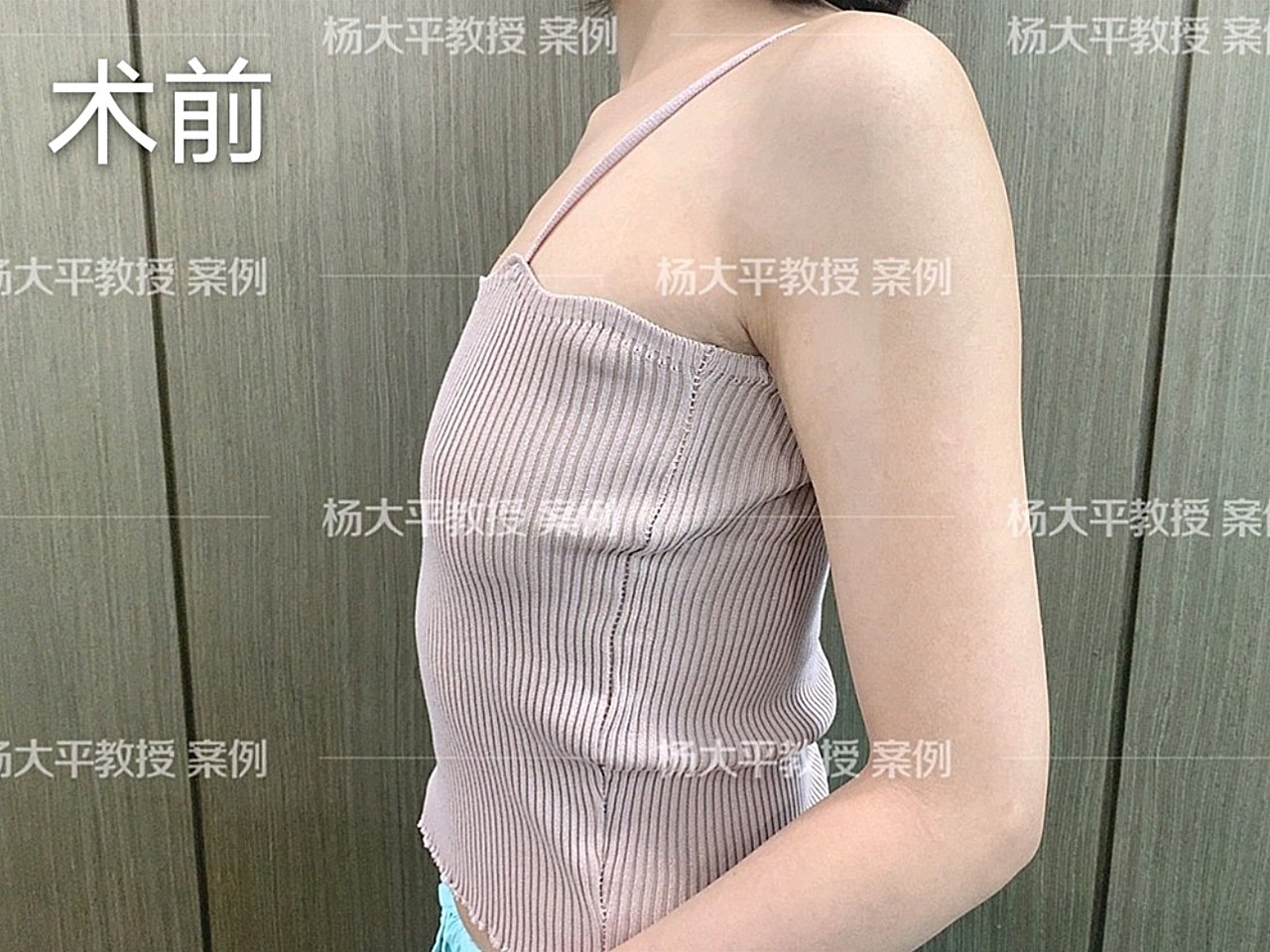 【娜绮丽假体隆胸第30天】