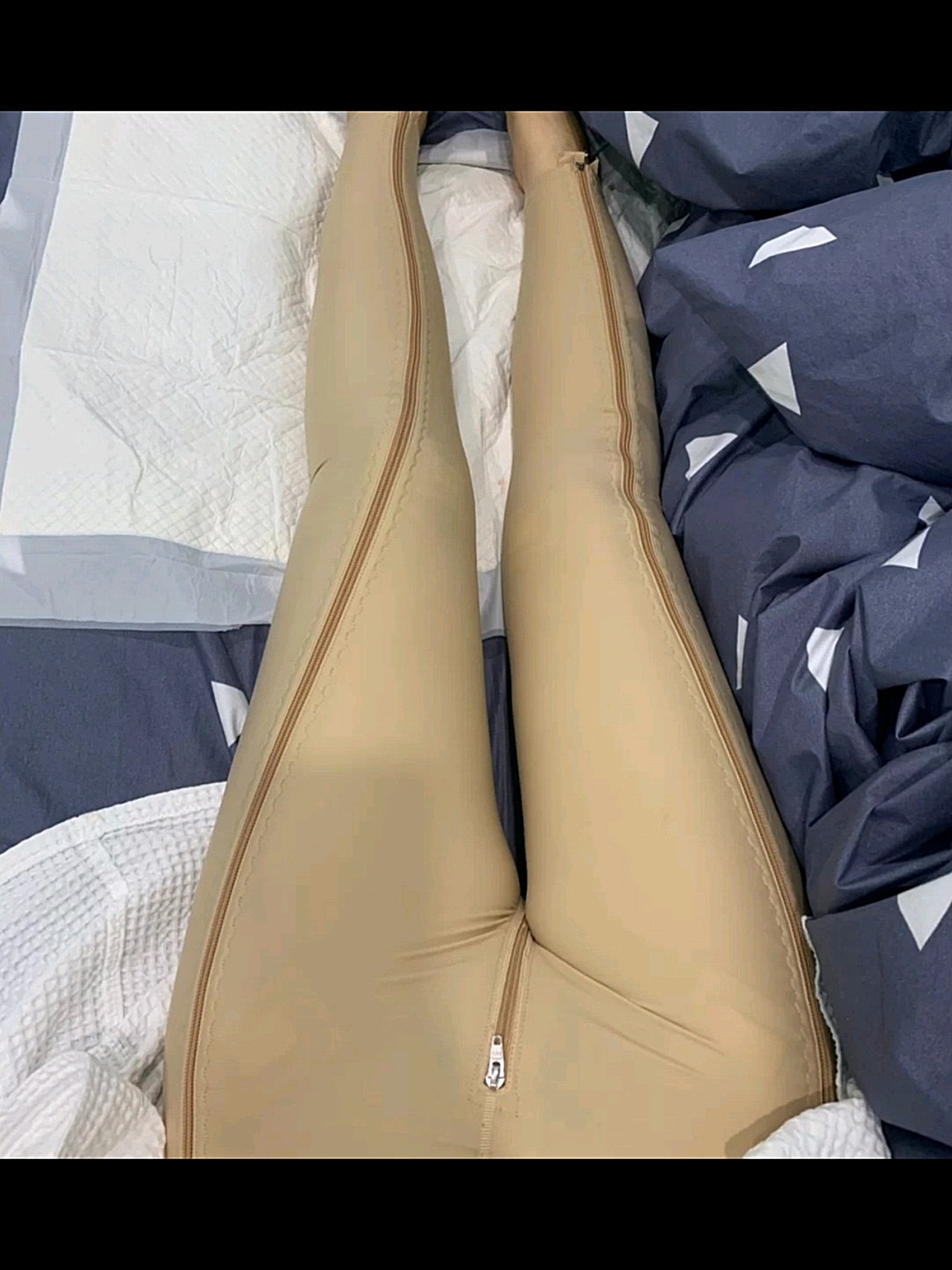 【沈阳汇美人大腿吸脂术后第1天】