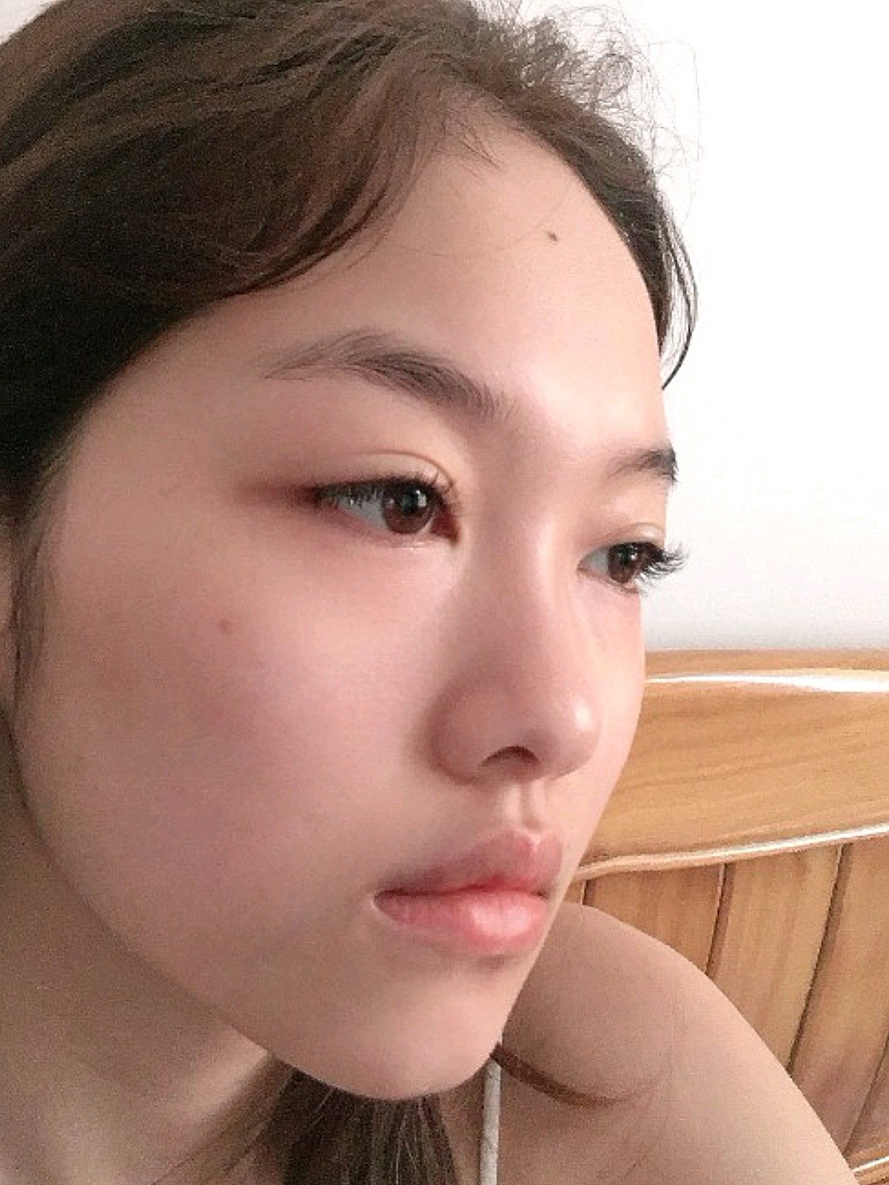 术前:亲们发现没有,我的鼻子,居然没有山根 ~ 今_圈子-新氧美容整形