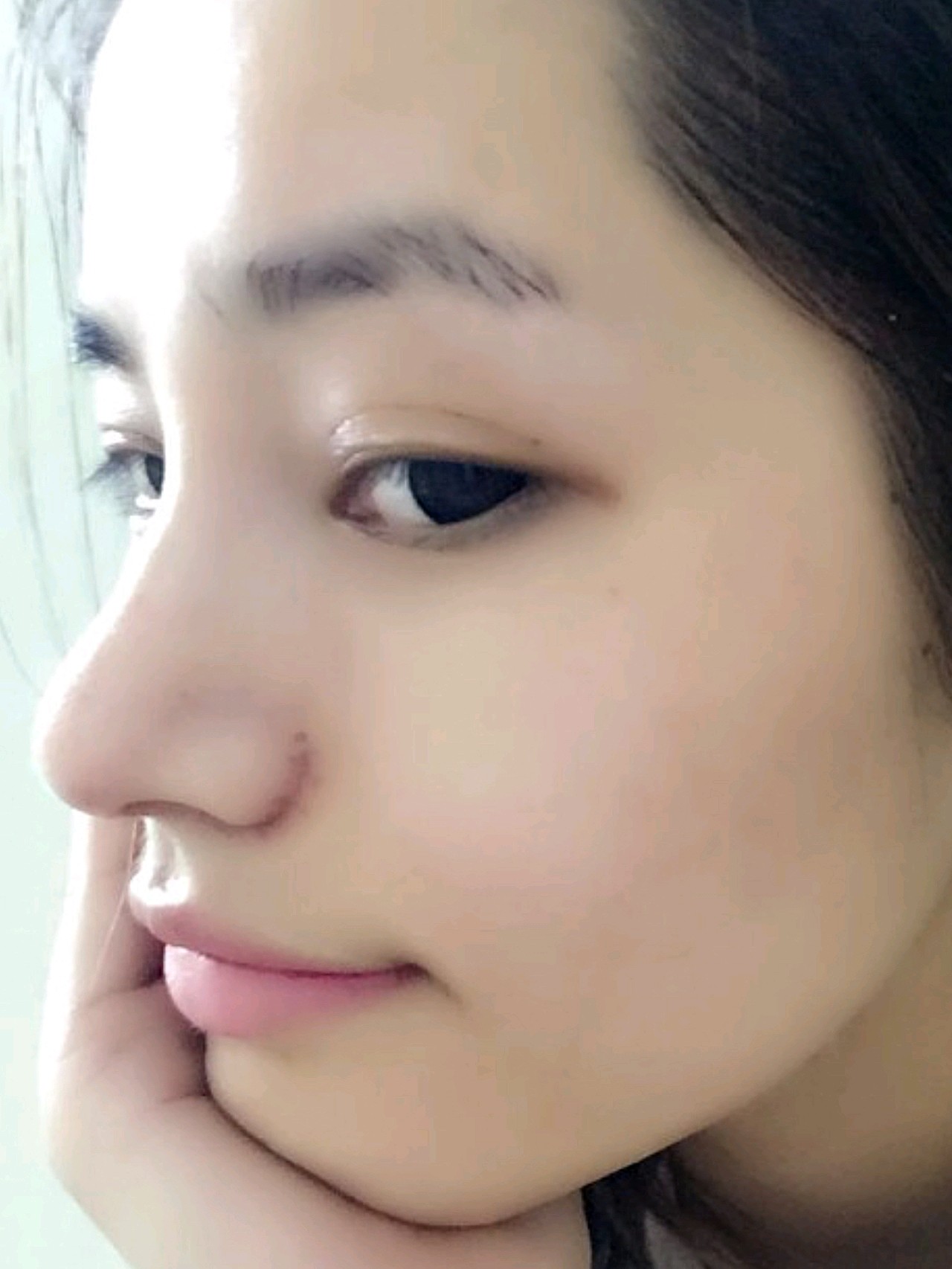 术前我的鼻头比较大,鼻翼也比较宽,侧面看着很扁平,_圈子-新氧美容