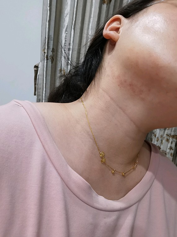 刚做完的第二天和第三天,下颌线部位有些轻微的出痧,五天过去就已经没