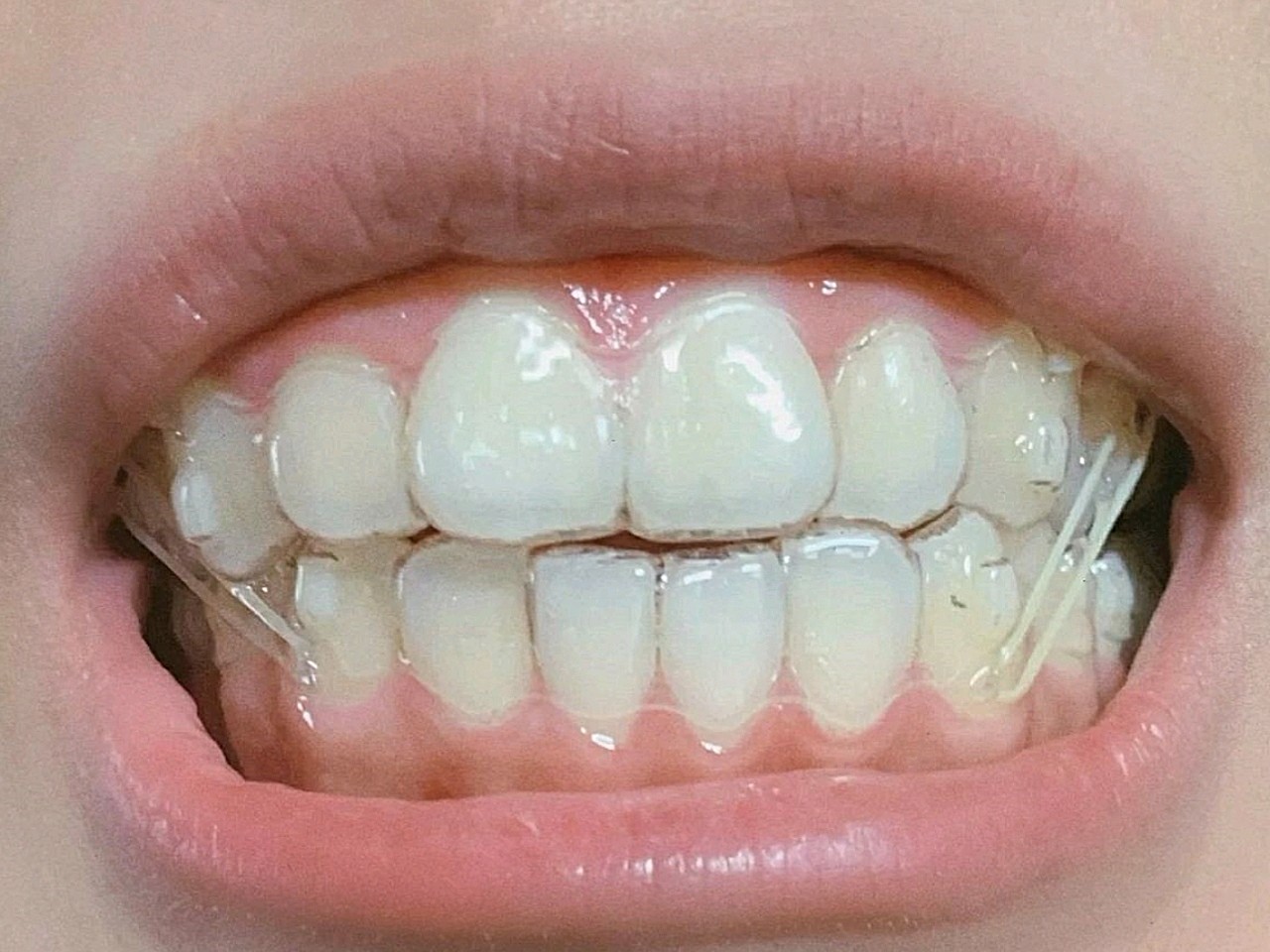 没拔牙隐形矫正戴的有点舒适,一直都是片切,片切之后_圈子-新氧美容