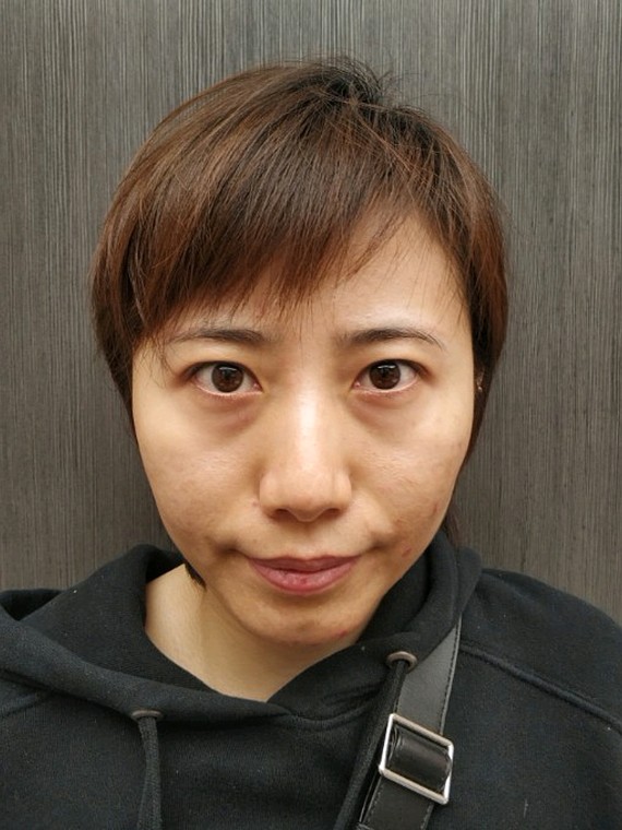 眼袋显得人憔悴,还显老,在网上搜了搜,了解了下祛眼_圈子-新氧美容