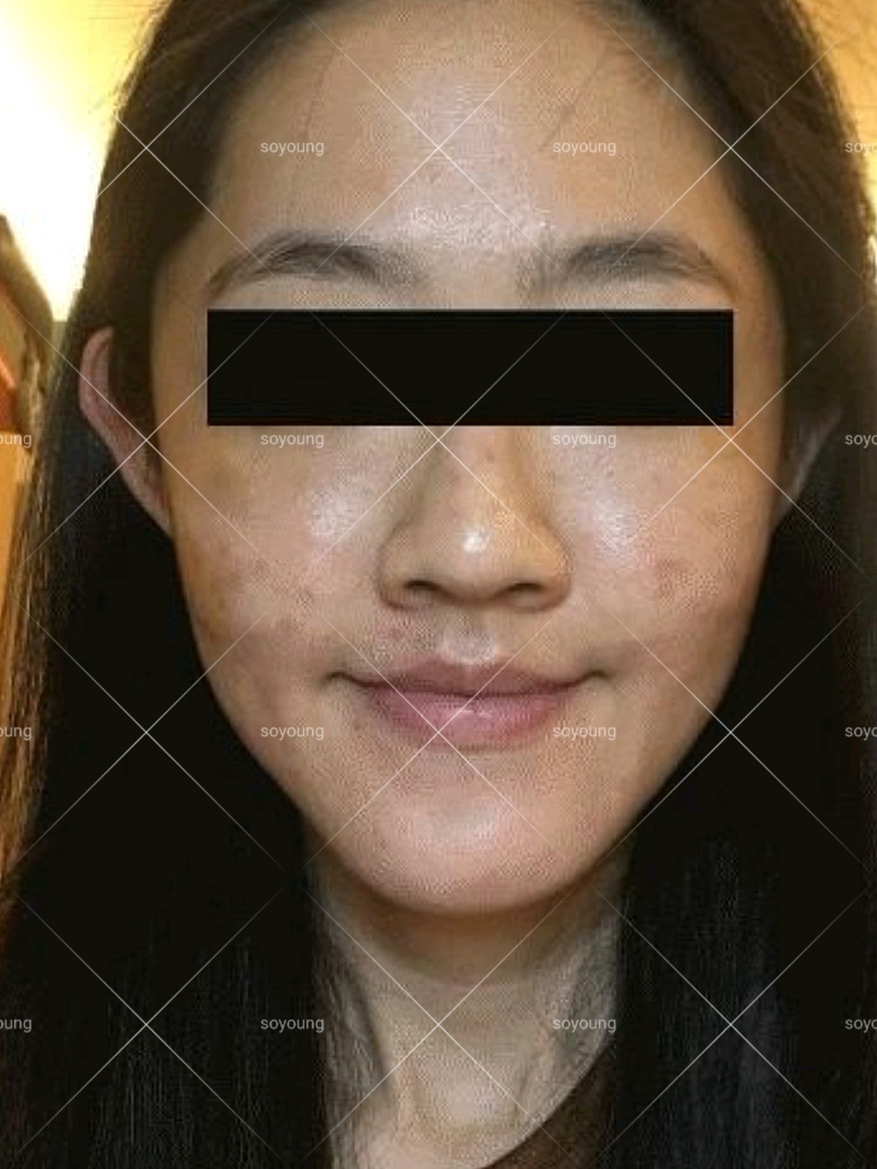 照片都是晚上同一个位置拍的!皮肤真的肉眼可_圈子-新氧美容整形