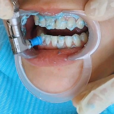 树脂贴面卸除或者超声波喷砂洁牙后的基牙含氟抛光步骤不能忽略