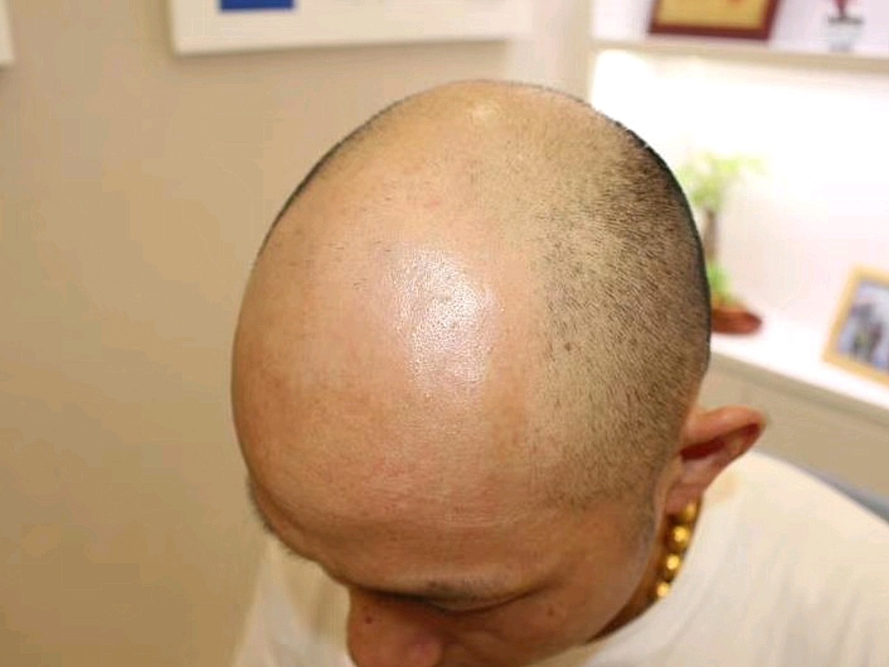 大面积脱发,自已都想放弃自己的,经过一年多的考查才_圈子-新氧美容