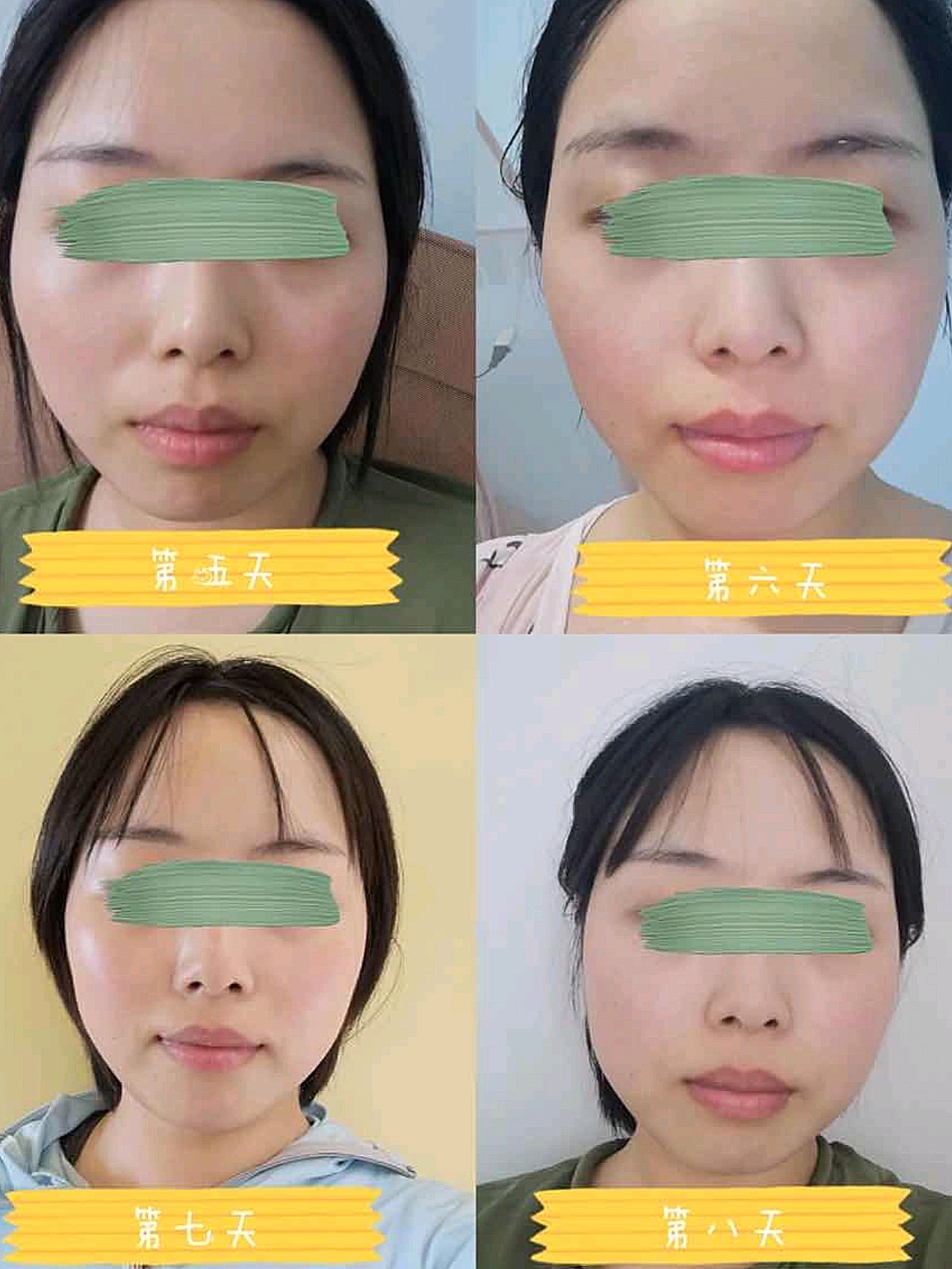 脸有点肿肿的 原本脸上就有红血丝,做完热拉提敷个面膜当天就恢复