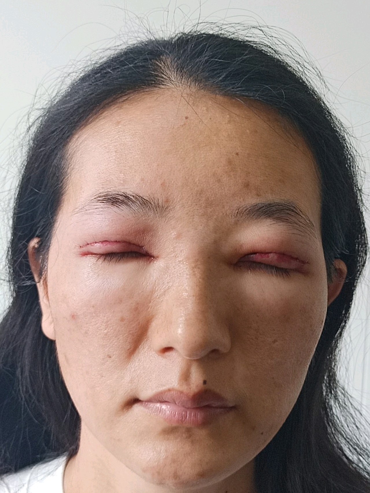 做了双眼皮和内眼角修复,这是术后第一天的照片,肿的_圈子-新氧美容