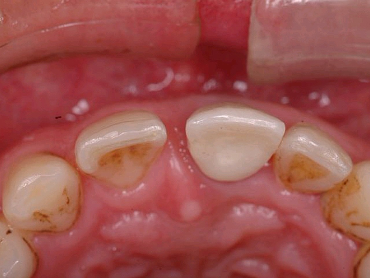 对我说如果要种植大概要经历骨增量手术和切牙孔神经切除术