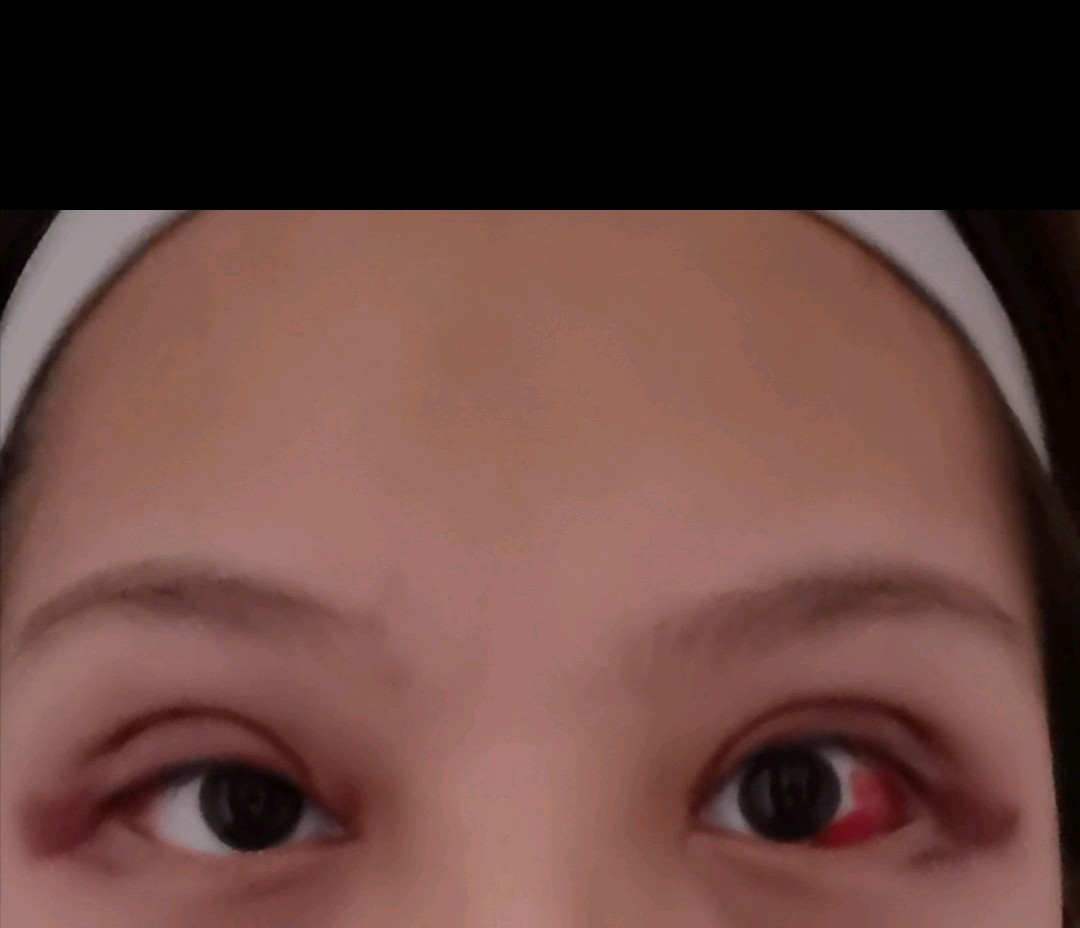 双眼皮第二天这是肿还是割坏了