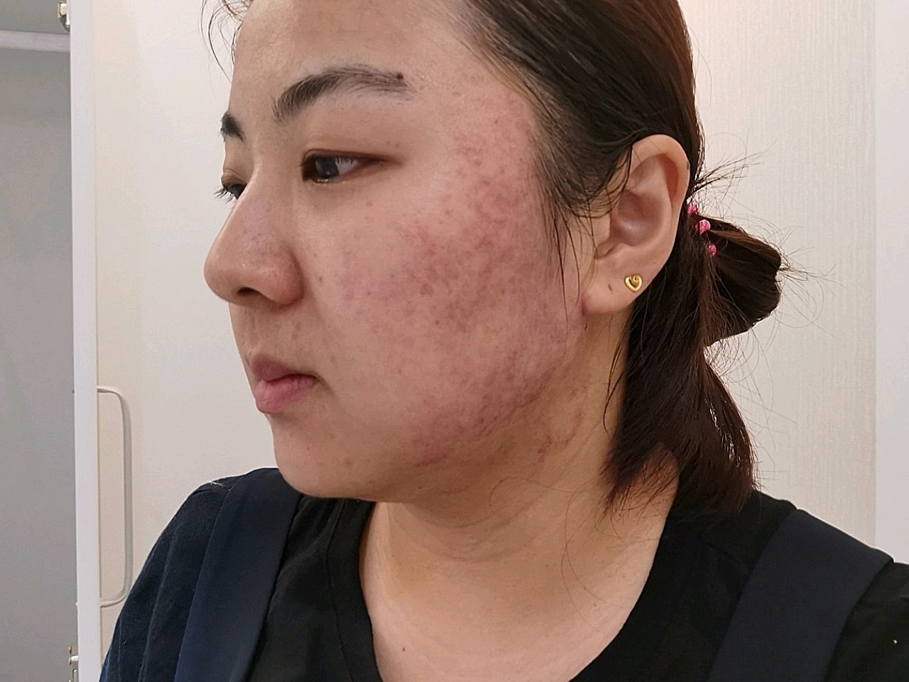 热拉提plus治疗的当天脸颊就有明显出痧,虽然不是很严重,但是看着