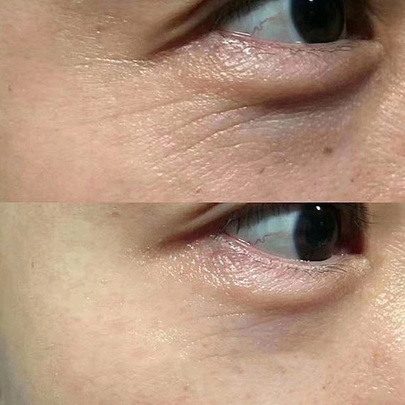 直接上图对比,眼周一次抗衰效果真的很好,果然没有推_圈子-新氧美容