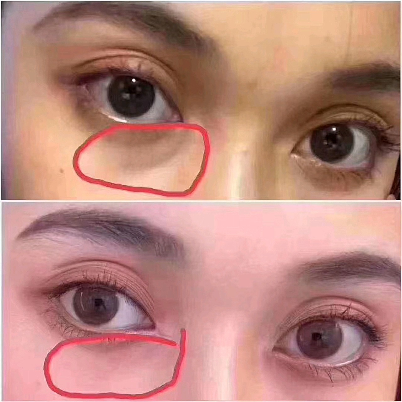 有什么办法即告别泪沟也能消除眼袋