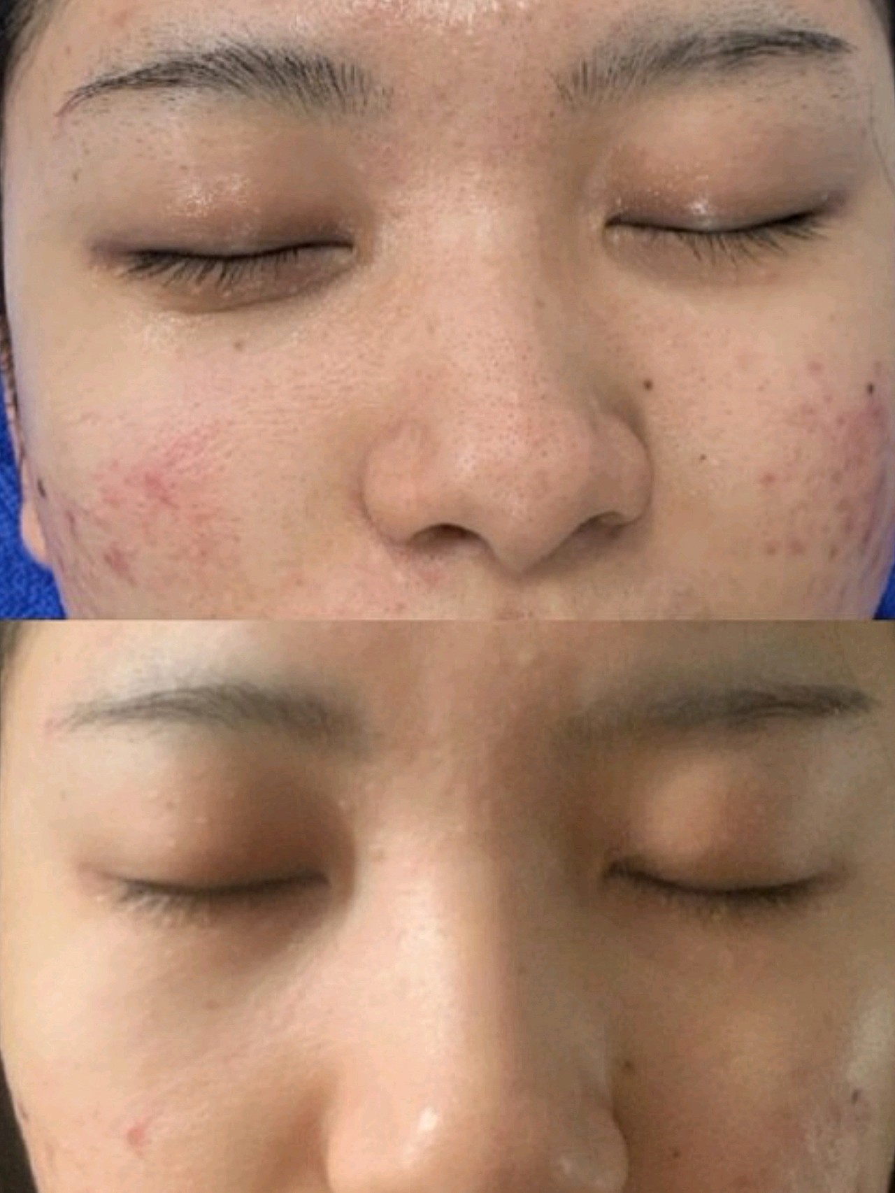 好评,红蓝光单独照光也很舒服,针清的小姐姐很细心,_圈子-新氧美容