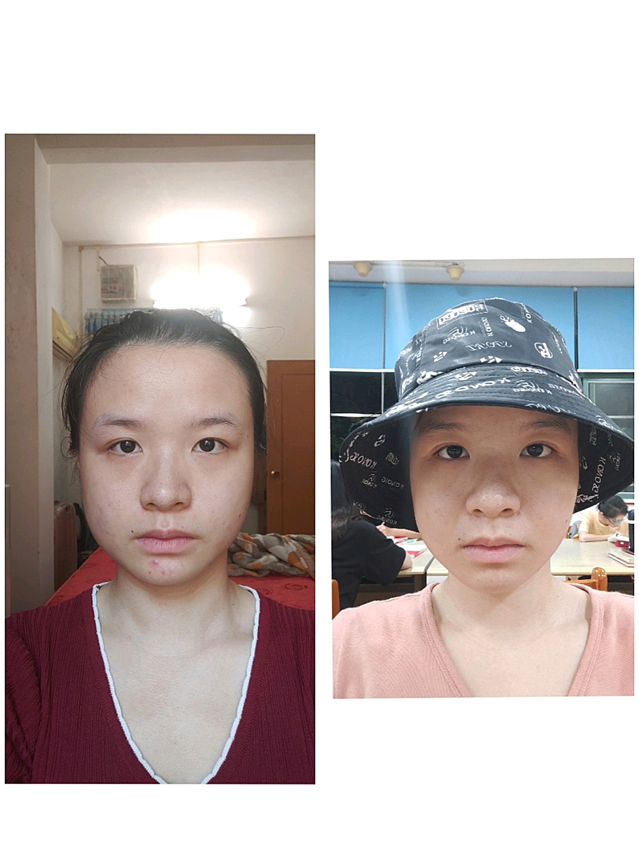 今天是打了瘦脸针的第五天!