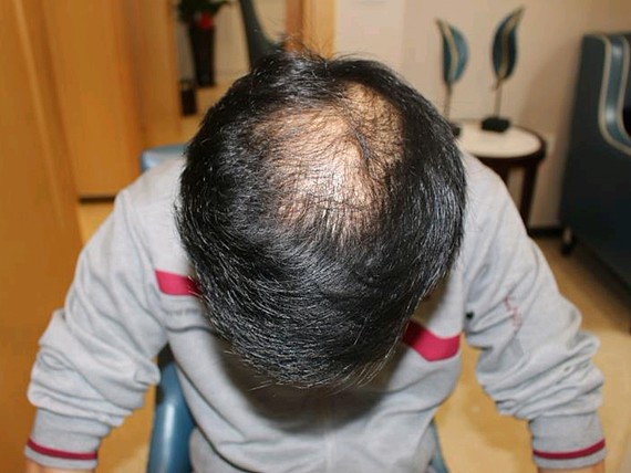 我属于天生的头顶秃,用生发液啥的一点效果也没有,没_圈子-新氧美容