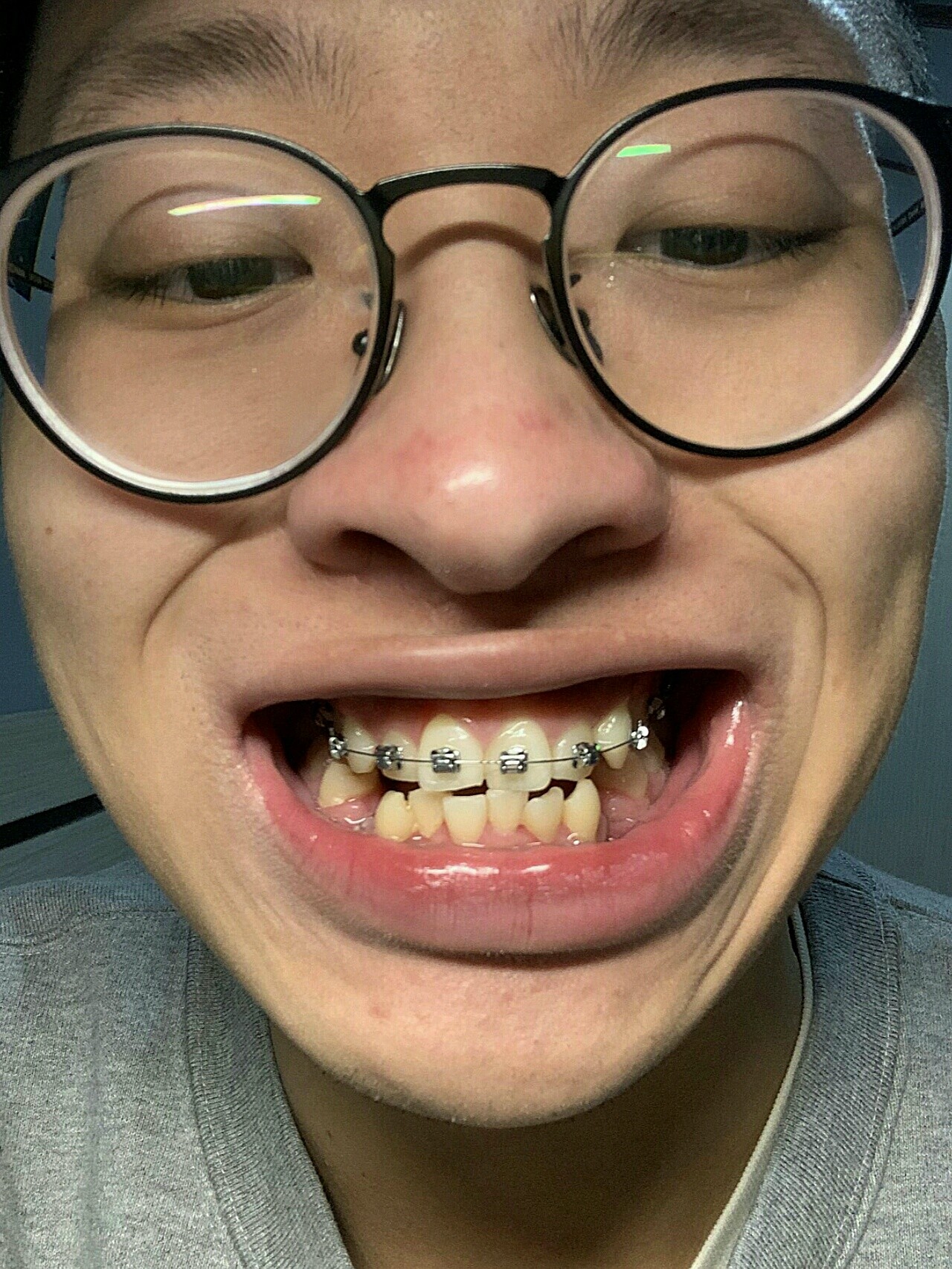 【金属自锁牙套第二篇】