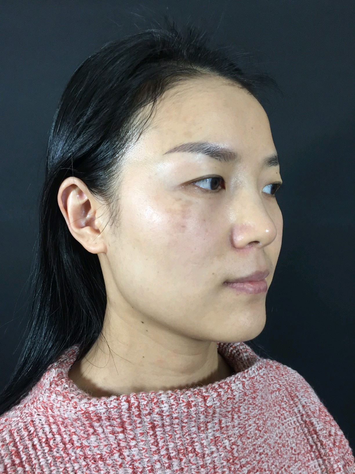 紫外线色斑虽然现在看不出来,但是随着年纪(晒太阳的_圈子-新氧美容