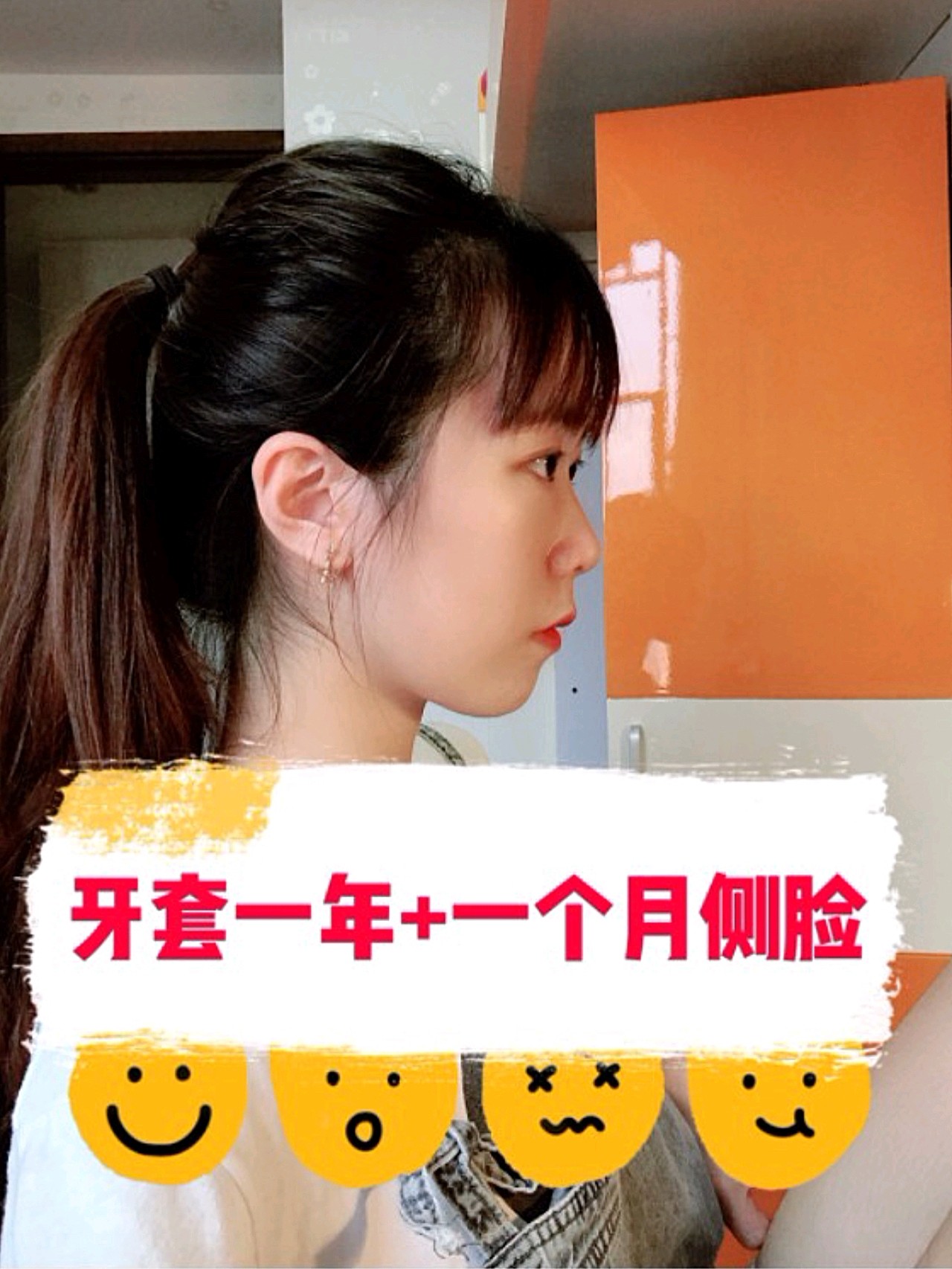 牙套一年一个月了侧脸变化真的超大