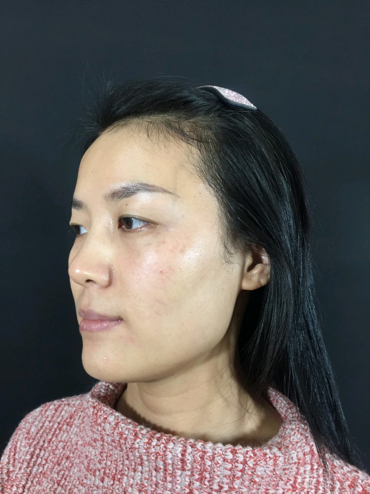 紫外线色斑虽然现在看不出来,但是随着年纪(晒太阳的_圈子-新氧美容