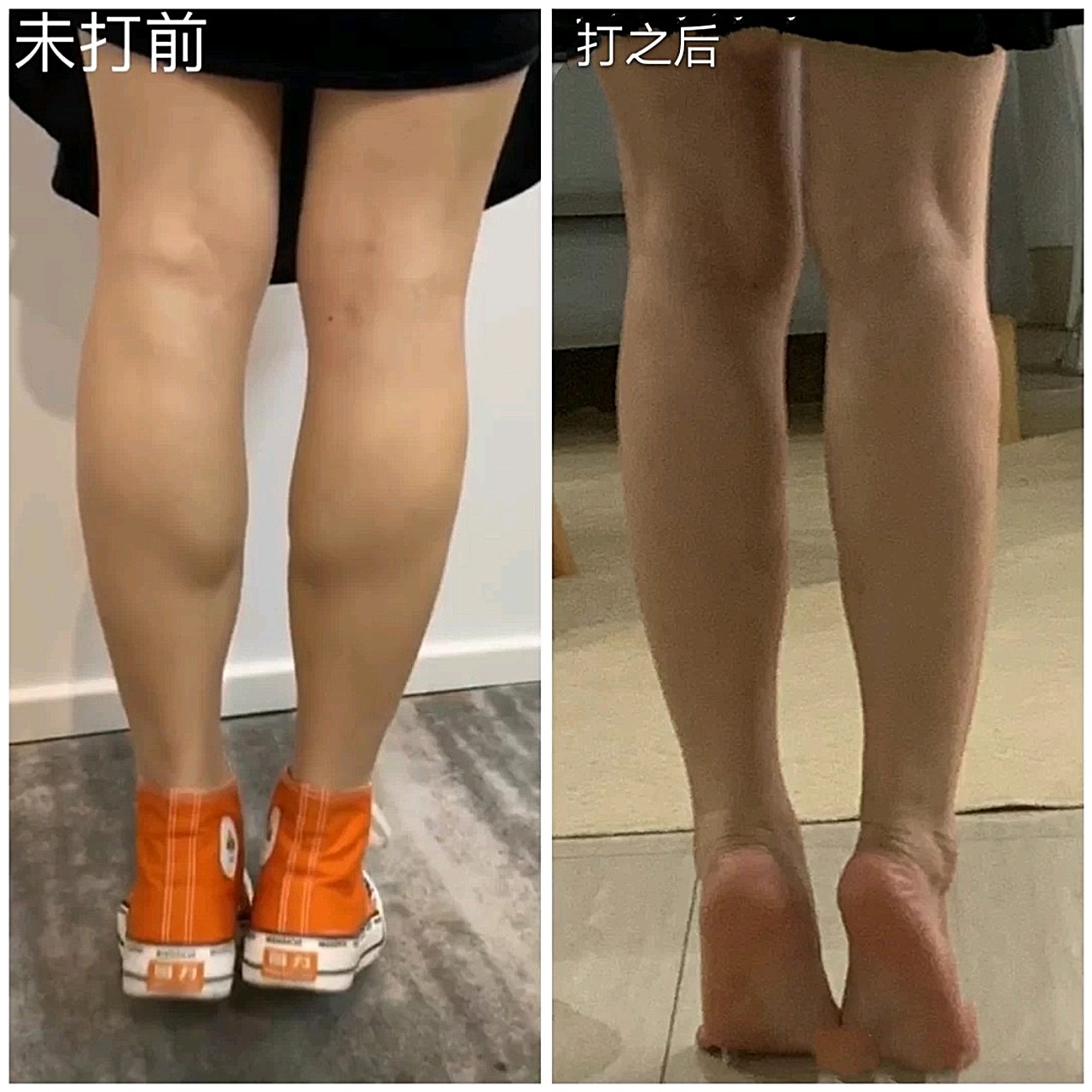 在办公室坐久了,小腿老是酸痛,肌肉堆积,整得小腿很_圈子-新氧美容