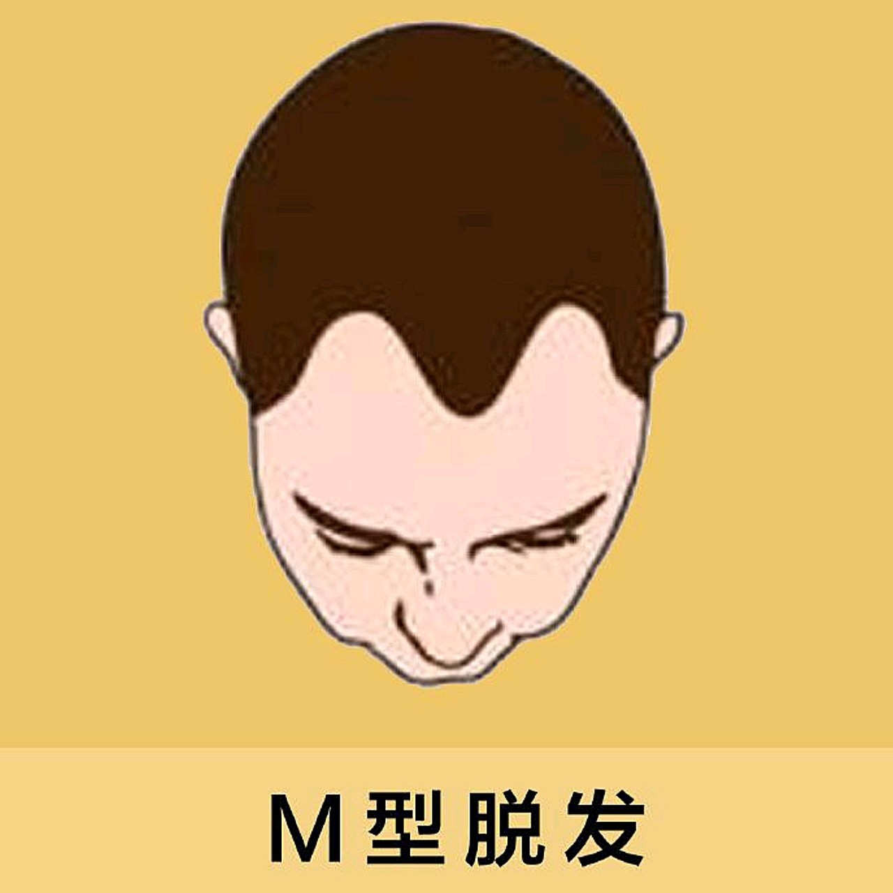 m型脱发除了脱发以外,还会有头发油和易怒的特点.