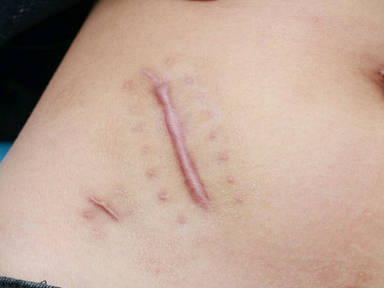 阑尾炎手术疤痕图图片