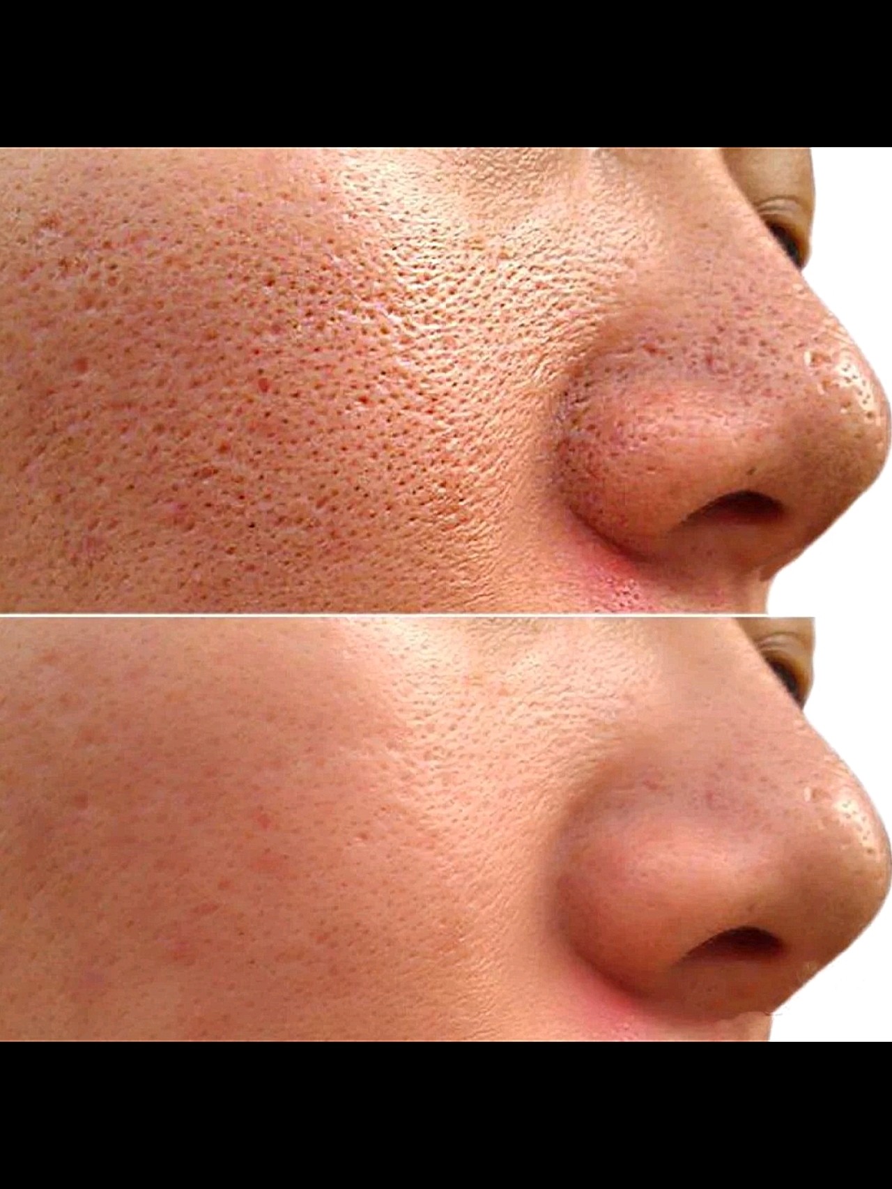 被撑大的毛孔通过护肤让它不要再变大,想收缩毛孔的话就只有医美的