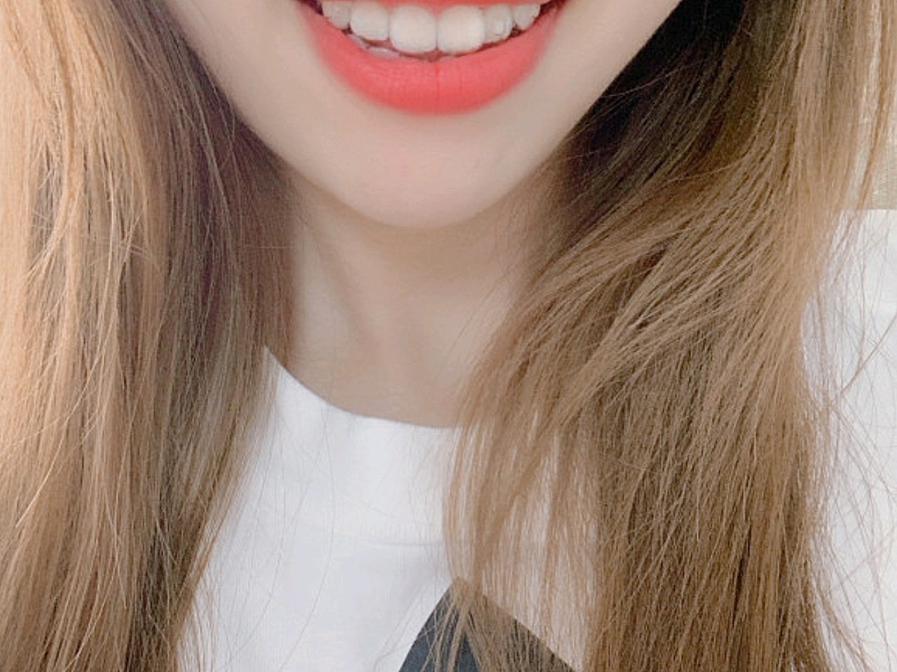 我拍照习惯抿着嘴,嘴巴里面像含了东西,是因为上牙前_圈子-新氧美容