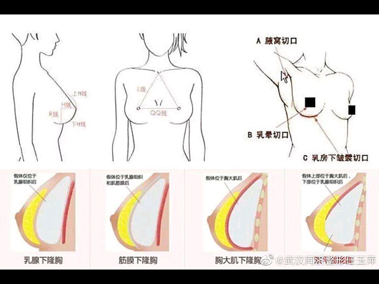 大致為:腋窩切口,乳暈切口和乳房下皺壁切口.