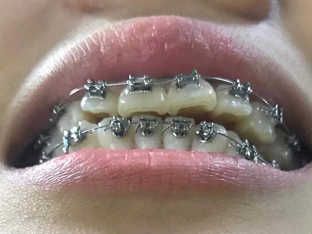 还有一个月牙套就要毕业啦