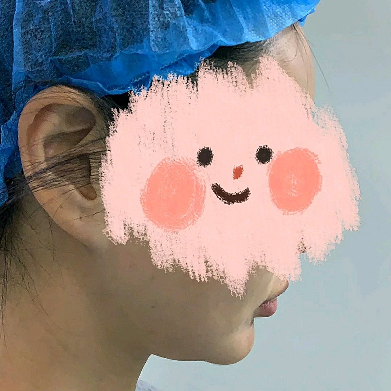 主要是面部轮廓不清晰,还有双下巴比较明显,这是术前_圈子-新氧美容