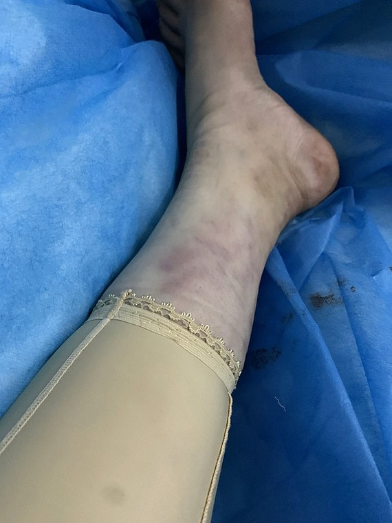 记录大小腿 脚踝 臀线吸脂