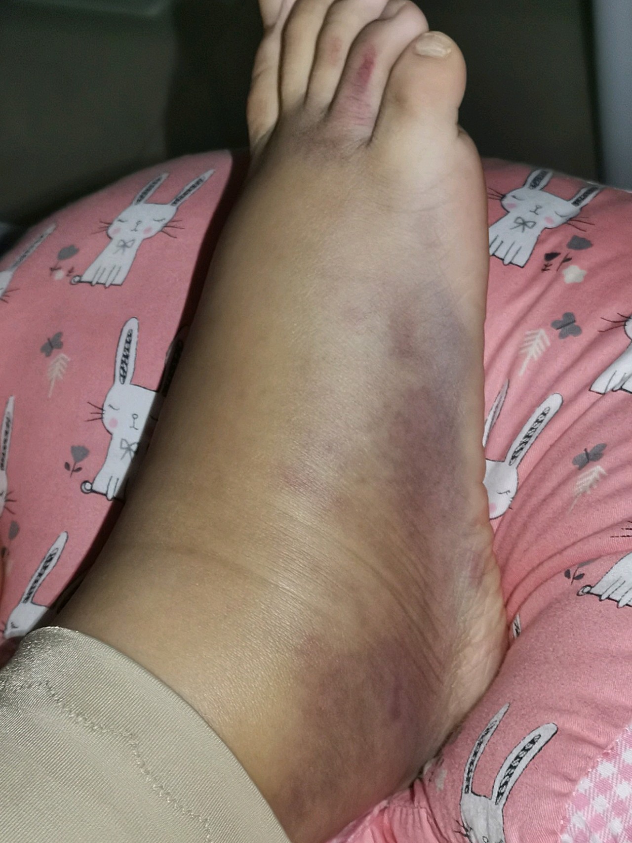 术后第7天了双脚自然水肿,而且伴有严重的青紫,甚至_圈子-新氧美容