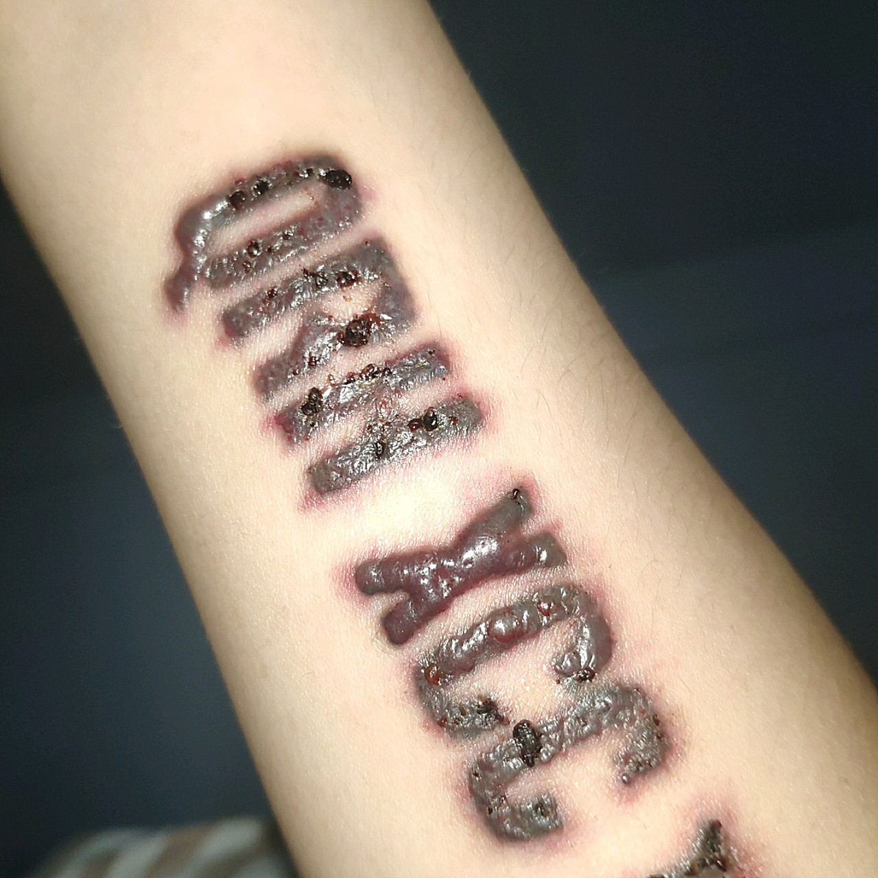 两天前 第二次激光洗纹身