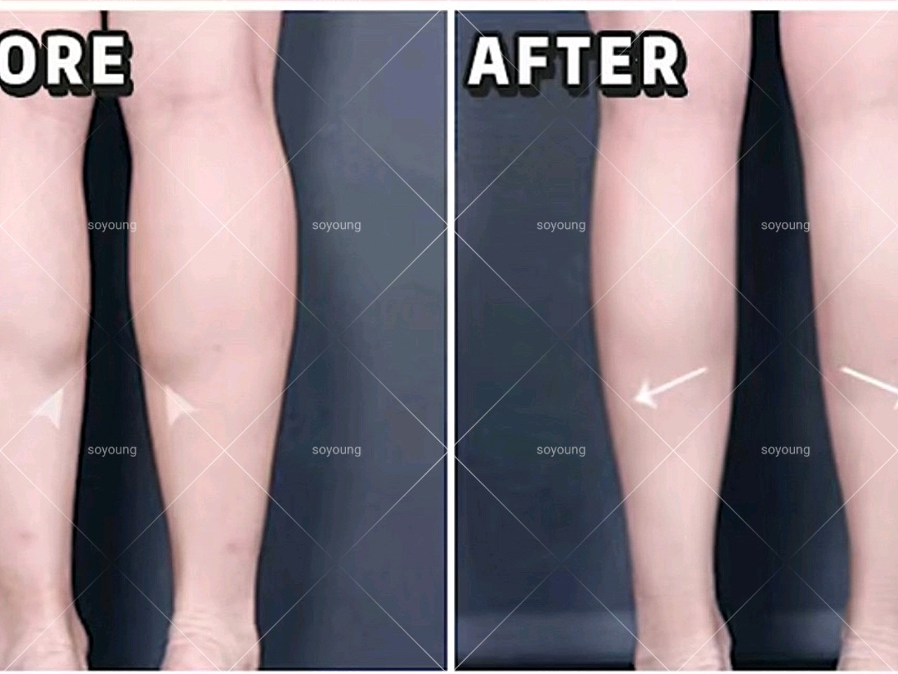 图片是我一共打了3次瘦腿针之后的效果 每隔半年