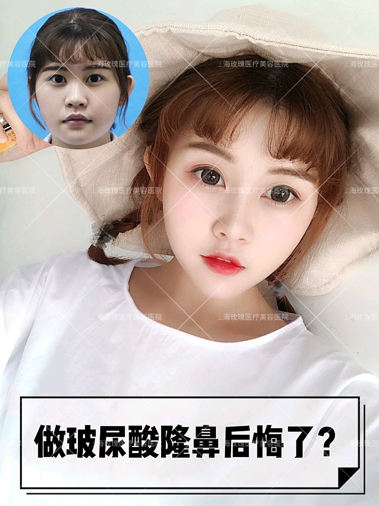 做玻尿酸隆鼻后悔了吗 我的鼻子山根很塌 鼻翼其实 圈子 新氧美容整形