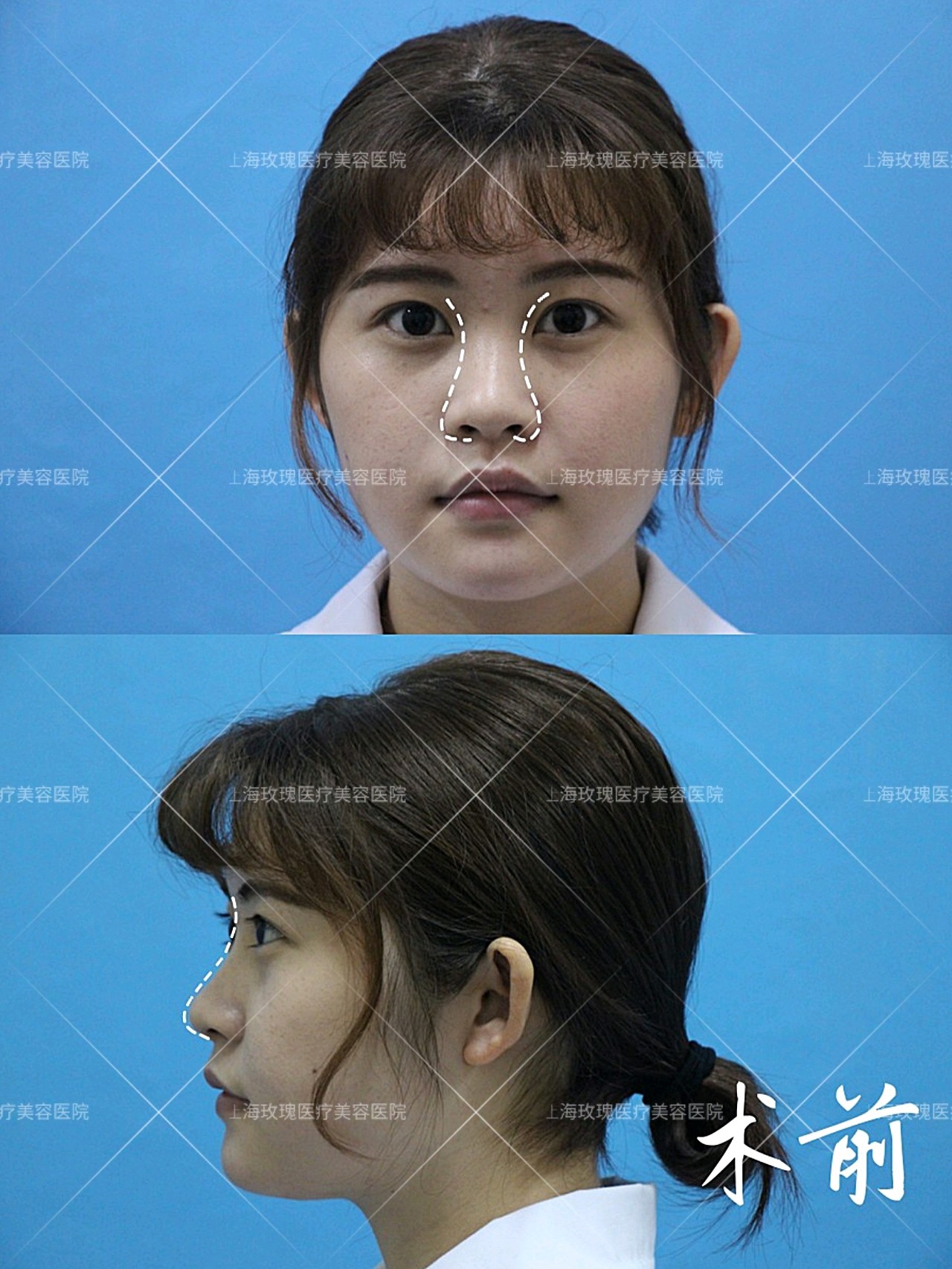 96我的鼻子山根很塌,鼻翼其实_圈子-新氧美容整形