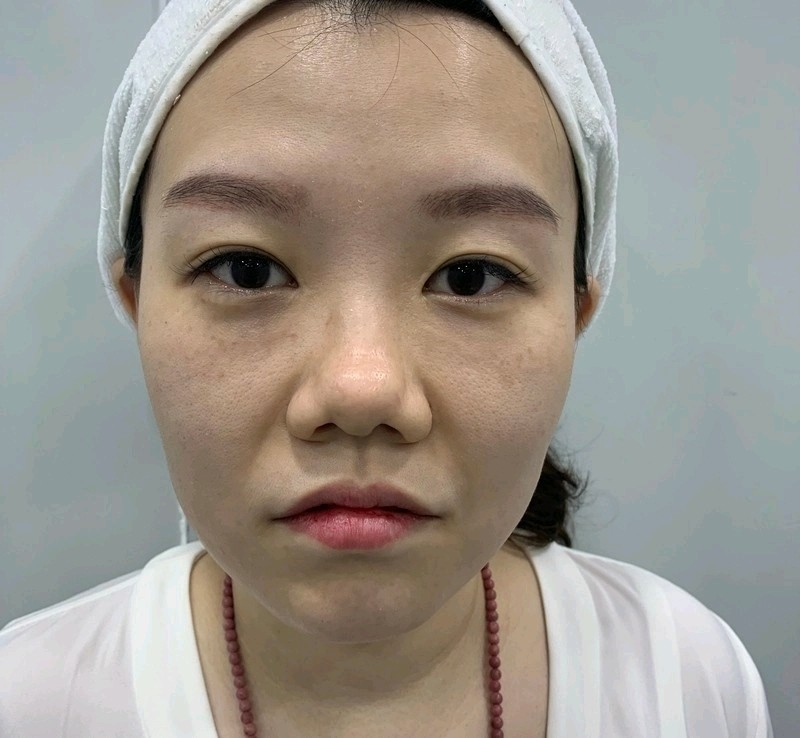 【术前诊断】:法令纹明显,皮肤整体状态松垮下垂【方_圈子-新氧美容