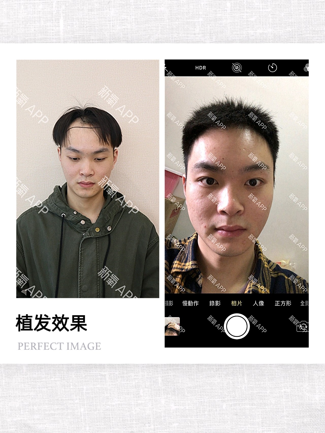 【头顶加密种植】头发稀疏加密种植 2000单位毛发种植 签约植发 存活