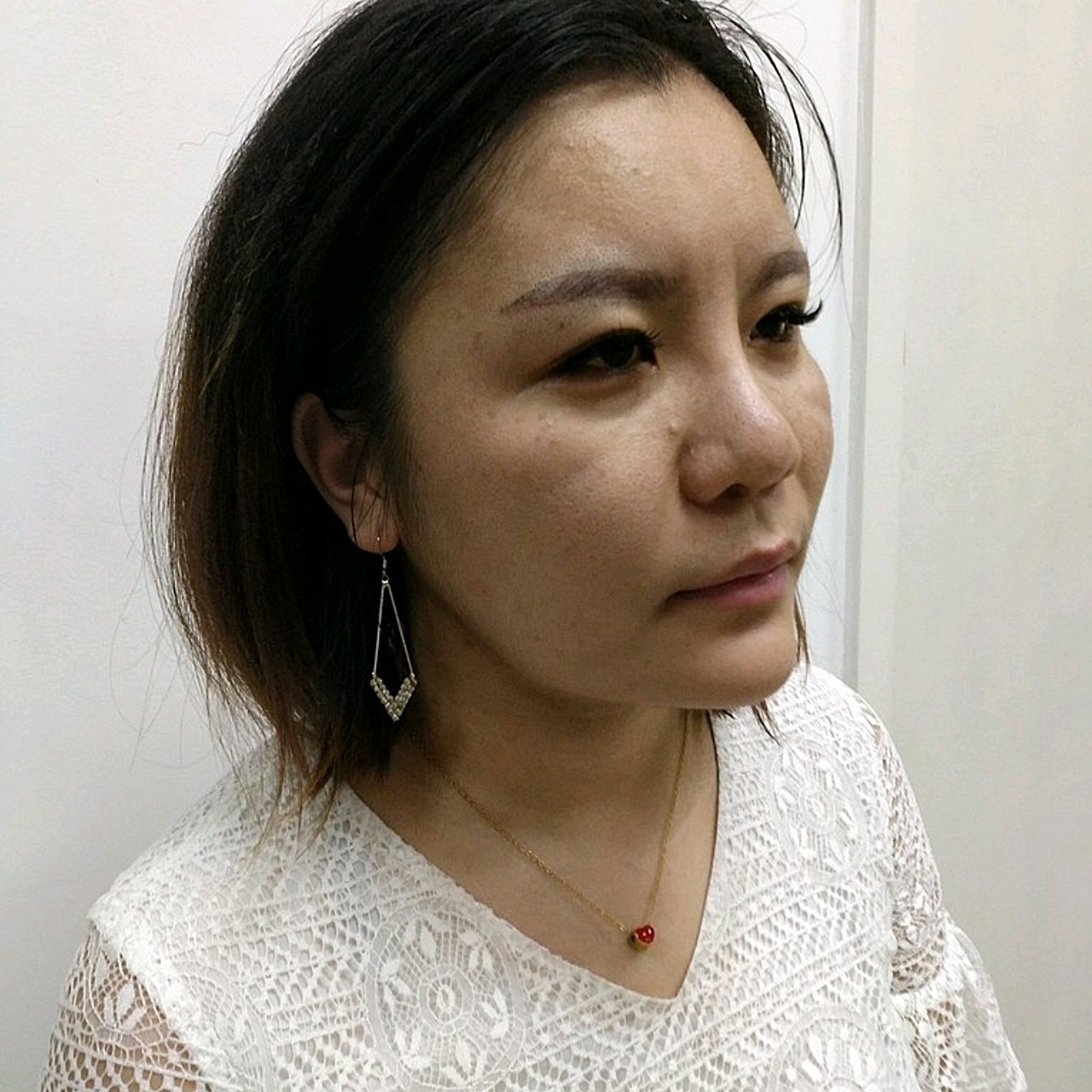 速愈美lt10线雕(术后15天)